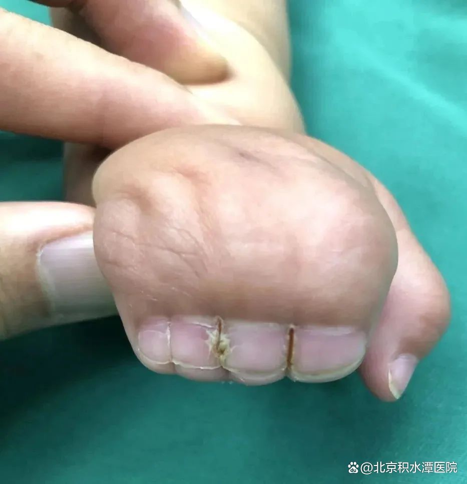 为你解读!apert综合征是什么"一往无前"-第2张图片-风筝网