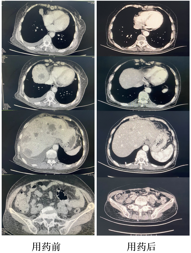 肺部ct复查结果显示:双肺多发微小结节,部分磨玻璃密度,细支气管炎,支