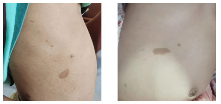 "咖啡斑"状的胎记,浙大二院&nbsp;图