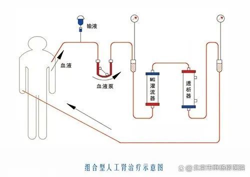 其原理是将患者的血液从体内引到体外循环系统内,通过灌流器中的吸附