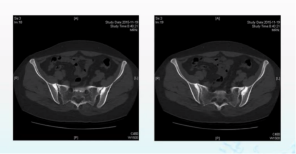 图2：患者骶髂关节CT