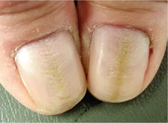 甲营养不良.图片来源:参考文献[6]