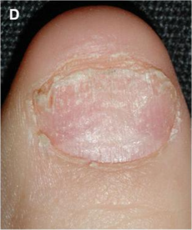 指甲月牙小,有竖纹,就是不健康?错!