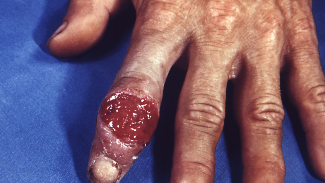 梅毒疹典型图片