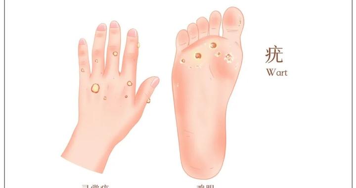 扁平疣丨这个病竟与HPV有关,还会影响颜值,该如何应对?|皮肤病|感染|火针|皮损|有效率_新浪新闻