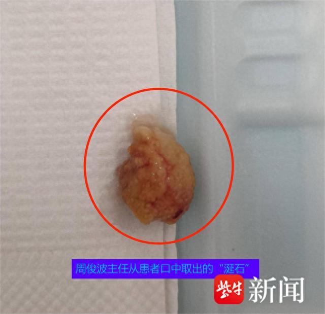 周俊波告诉记者,涎石病是指发生在涎腺腺体及其导管中的钙化性团块