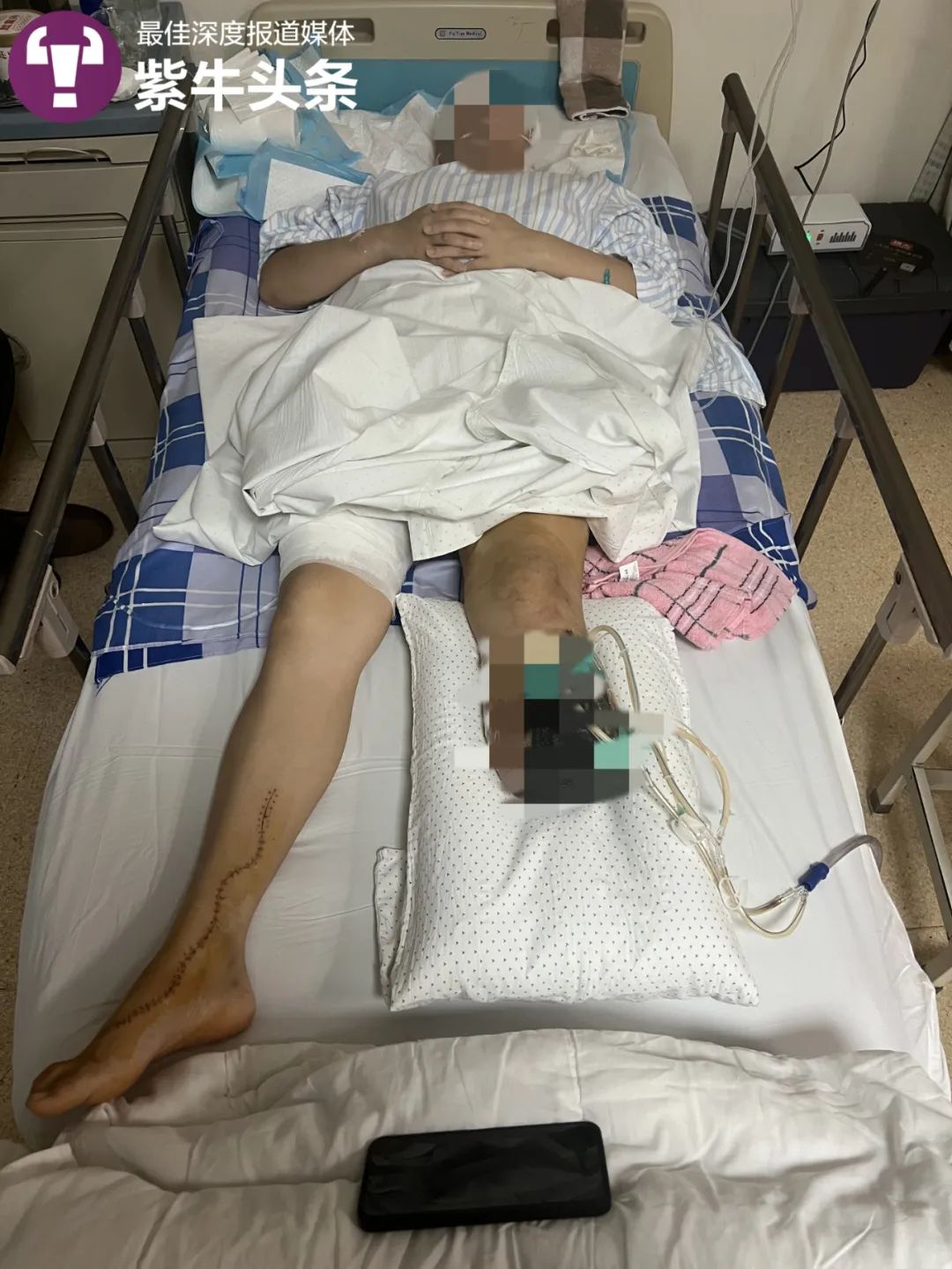 女大学生实习期间救人后被砸断腿截肢,合同没签,保险尚未