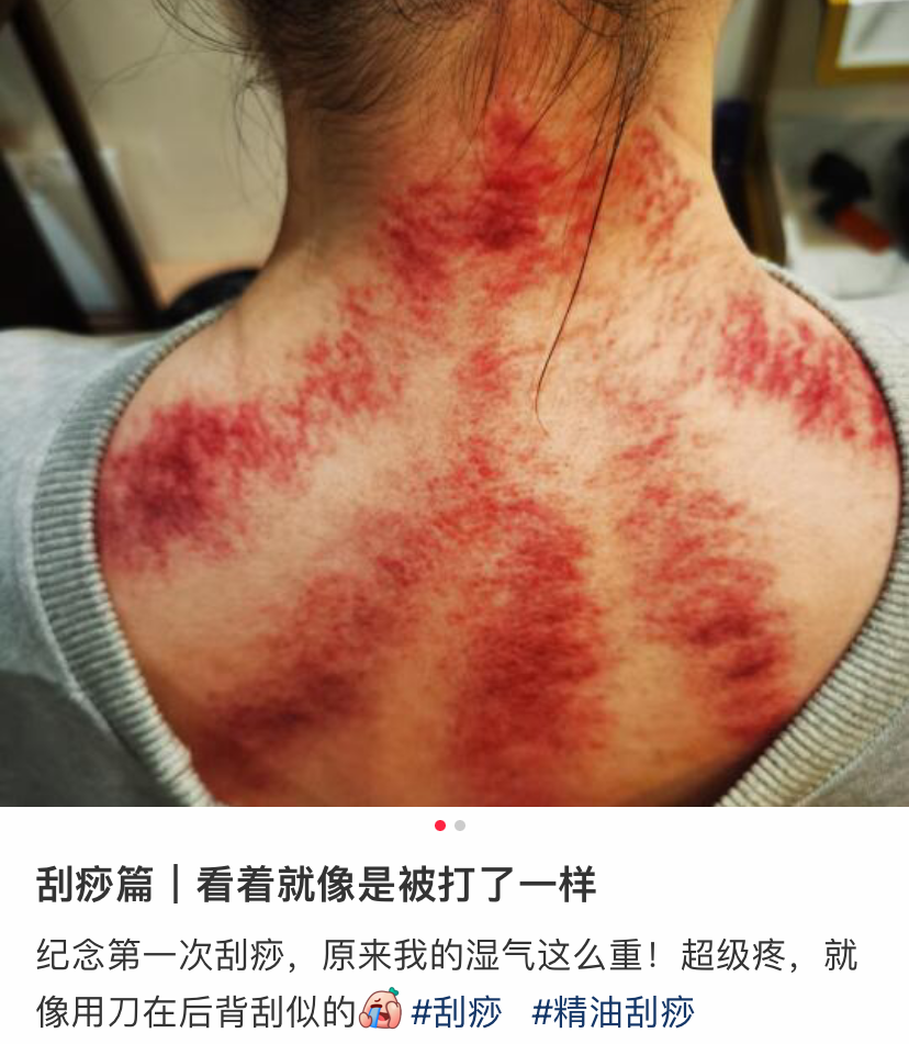 打工人的养生花背,社会大哥看了都说狠|刮痧_新浪财经_新浪网