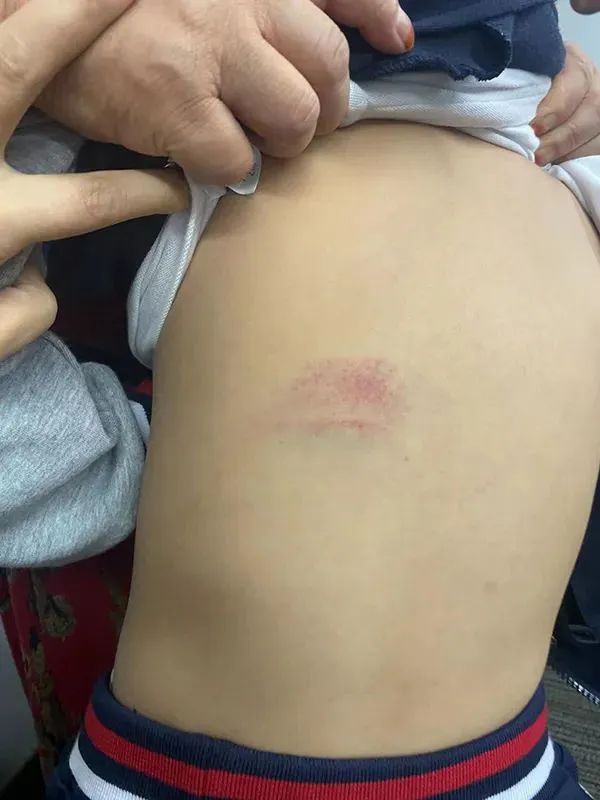 "7岁男孩被班主任殴打致多处淤青",学校回应:停职,警方已介入_新浪