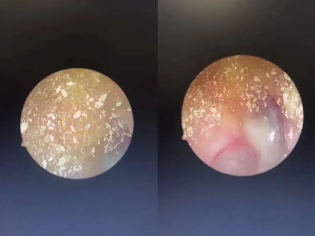 耳朵奇痒无比,罪魁祸首竟然是……|异物_新浪财经_新浪网