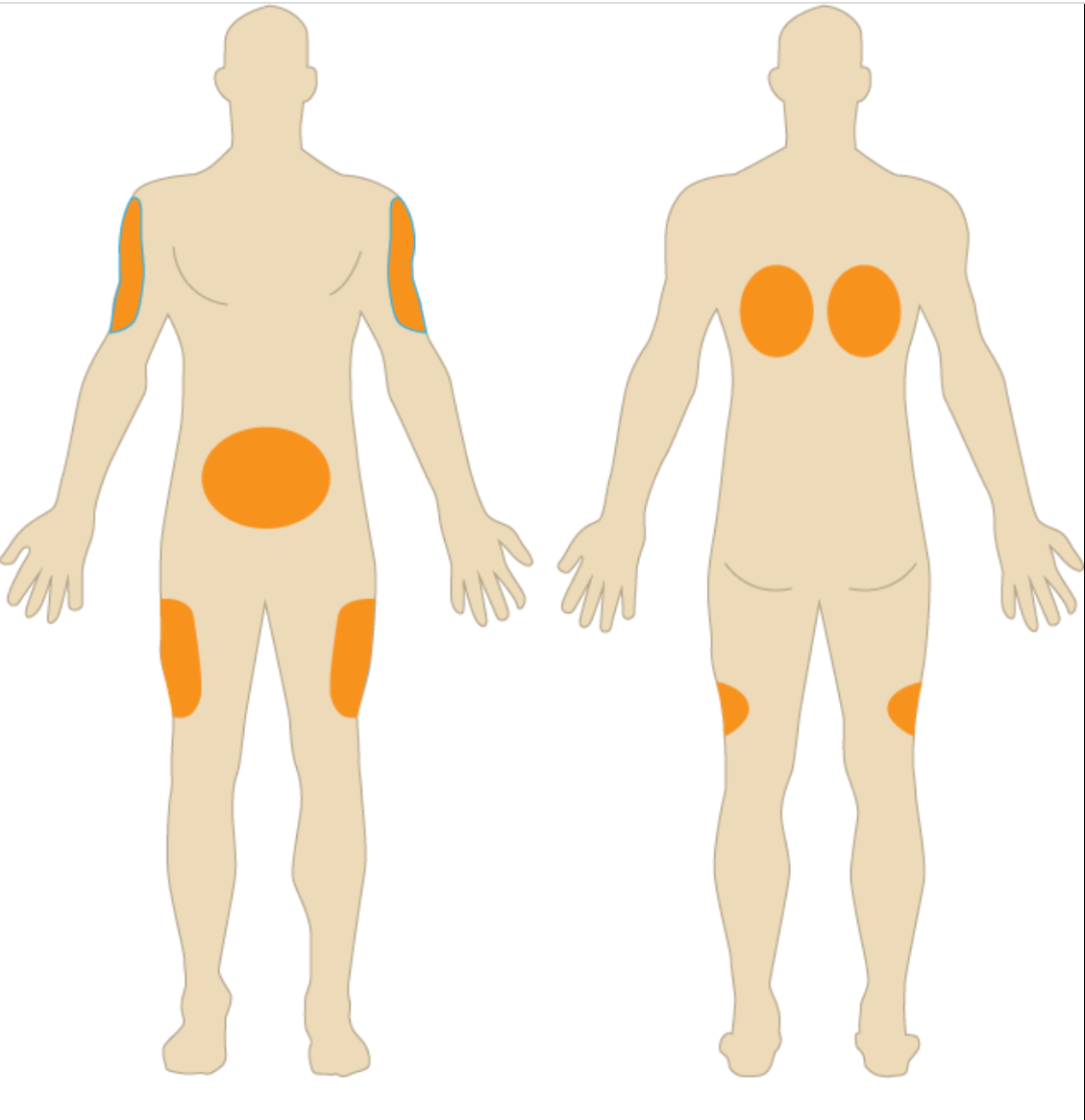 皮下注射区域,图片来源:wikimedia