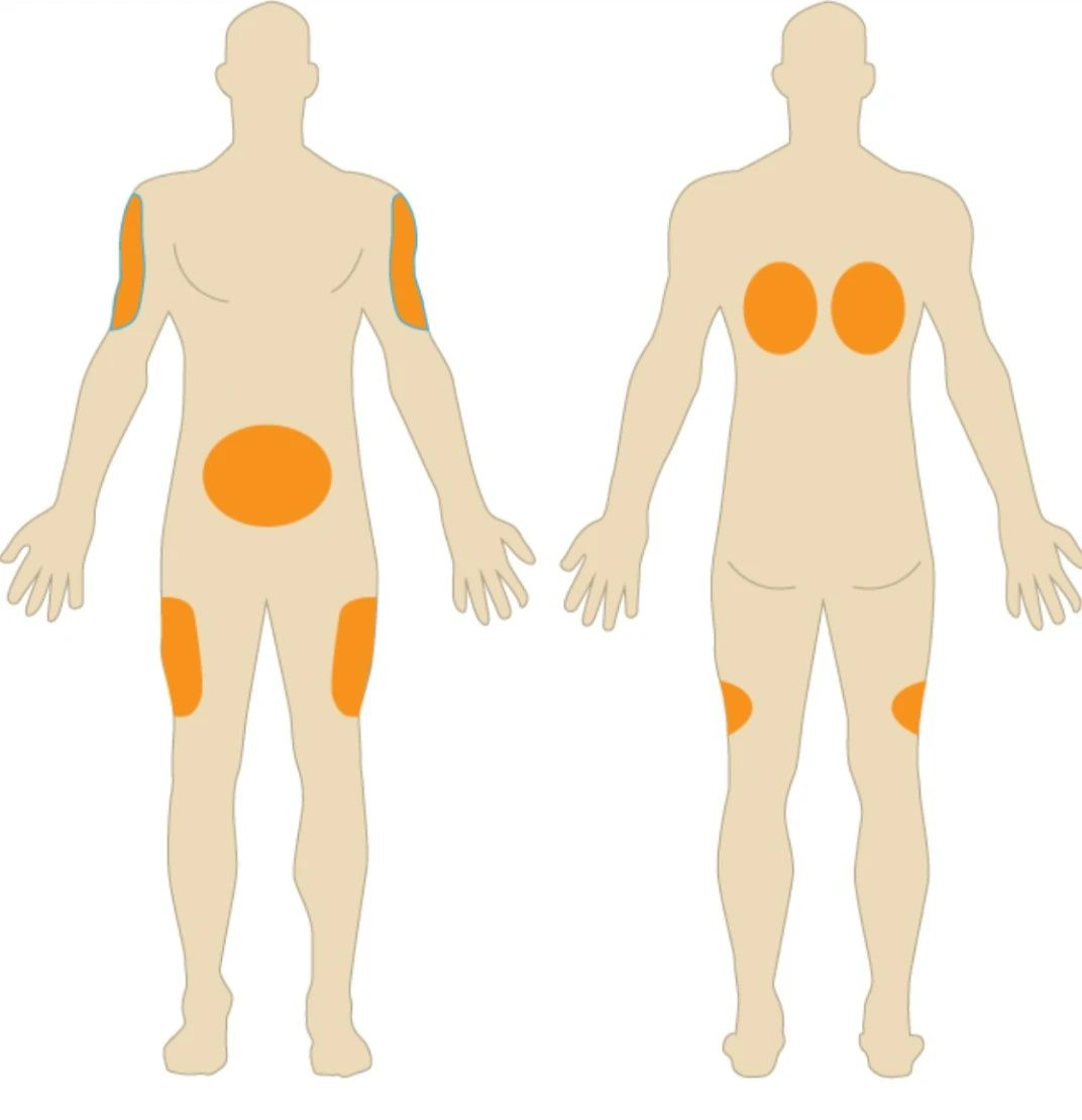 皮下注射区域.(图/wikimedia)