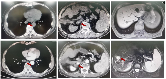 实例鉴证,携爱而行|尽显三线治疗中坚本色,呋喹替尼为中位直肠癌伴肝