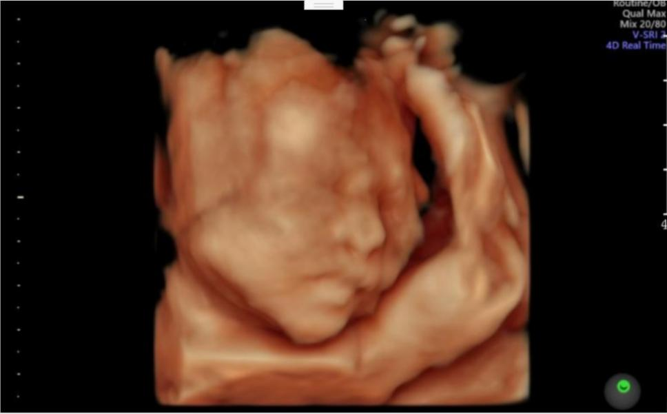很幸运,存活的那个胎儿羊水穿刺结果提示正常;胎儿的四维彩超和心脏