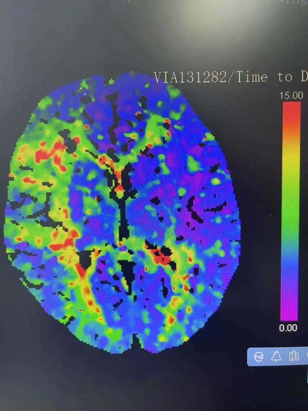 脑梗患者的血流灌注图.图片来源:宁波晚报
