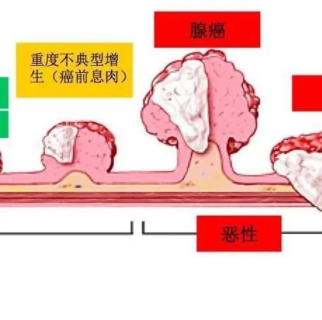 息肉,多是一团痰浊淤血留在了某个部位,一个妙方,能去死肌,蚀恶肉!|薏苡仁|乌梅|威灵仙_新浪新闻