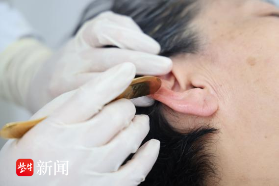 在规范治疗糖尿病的基础上,针对其症状给予耳部全息铜砭刮痧和中药