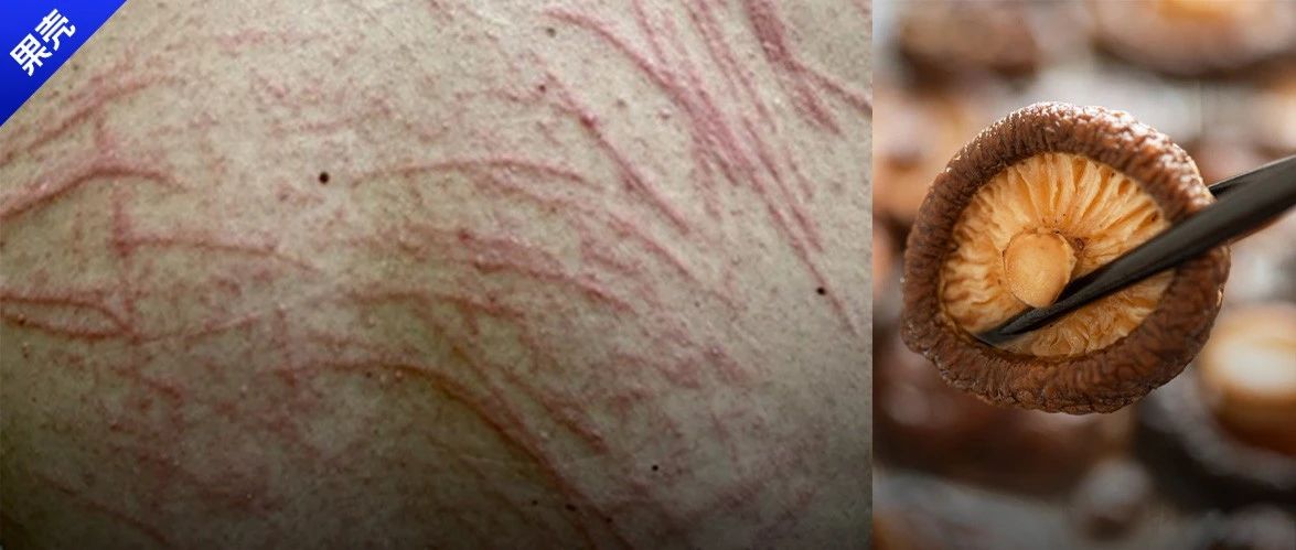 背上莫名出现“鞭痕”16年，每次都跟这种蘑菇有关……|皮炎_新浪新闻