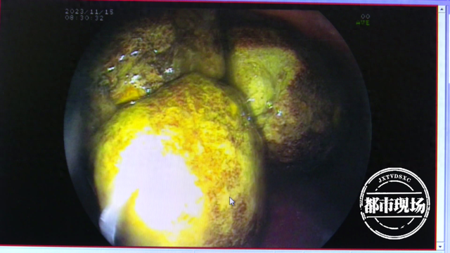 丁先生就医后胃镜检查的图片