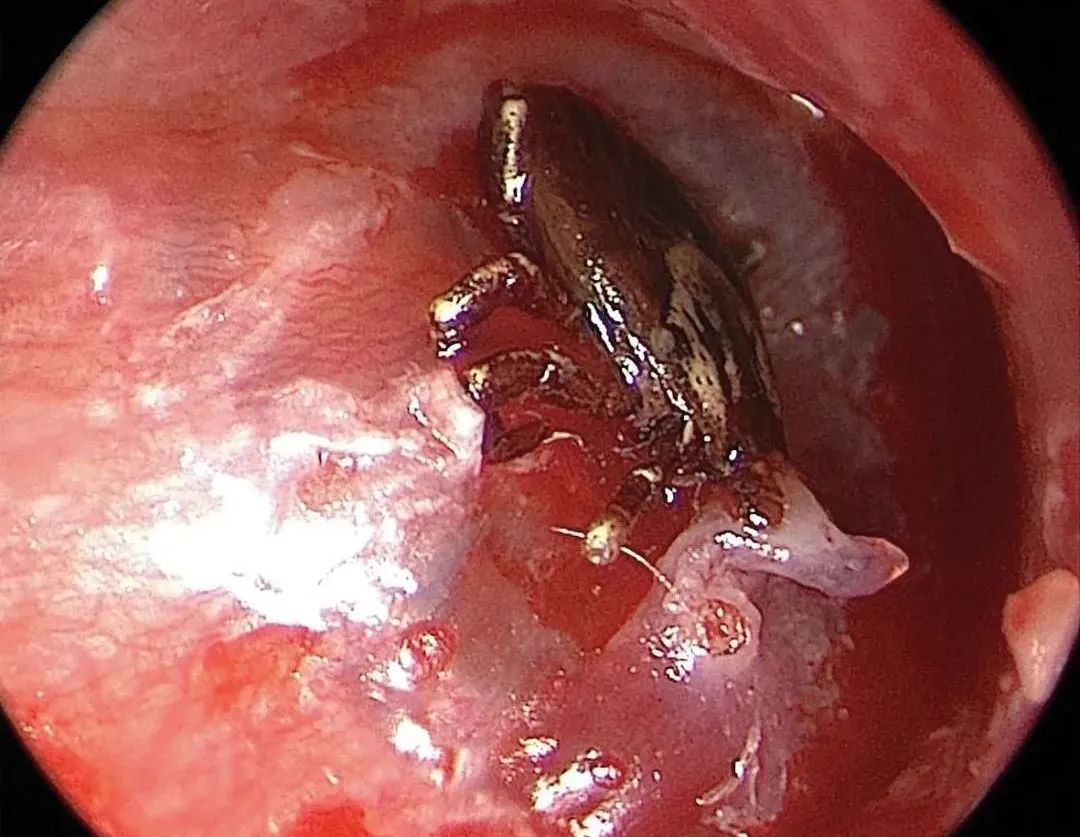 她耳朵里一直传来声音,原来是蜘蛛在里面爬,还完成了蜕皮|耳朵_新浪