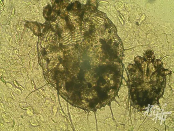 疥虫成虫和幼虫 医院供图