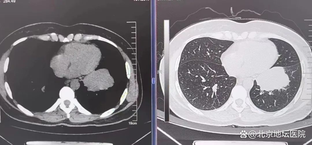 肺癌又脑转移 发现已是晚期!多学科诊疗让患者绝处逢生