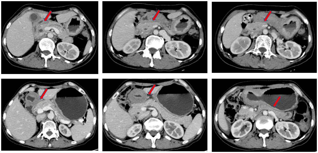 实例鉴证,携爱而行|局部晚期胃癌患者呋喹替尼联合紫杉醇转化治疗后