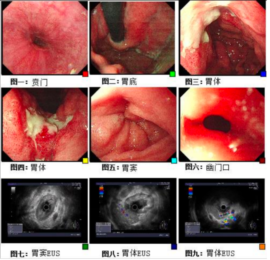 实例鉴证,携爱而行|局部晚期胃癌患者呋喹替尼联合紫杉醇转化治疗后