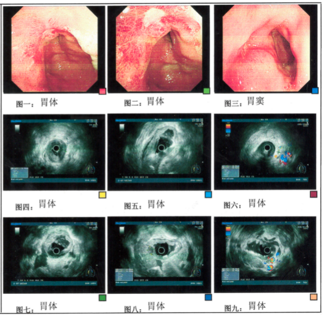 实例鉴证,携爱而行|局部晚期胃癌患者呋喹替尼联合紫杉醇转化治疗后