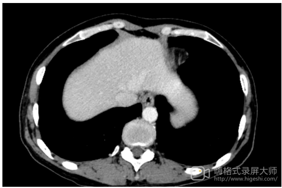 实例鉴证,携爱而行|局部晚期胃癌患者呋喹替尼联合紫杉醇转化治疗后