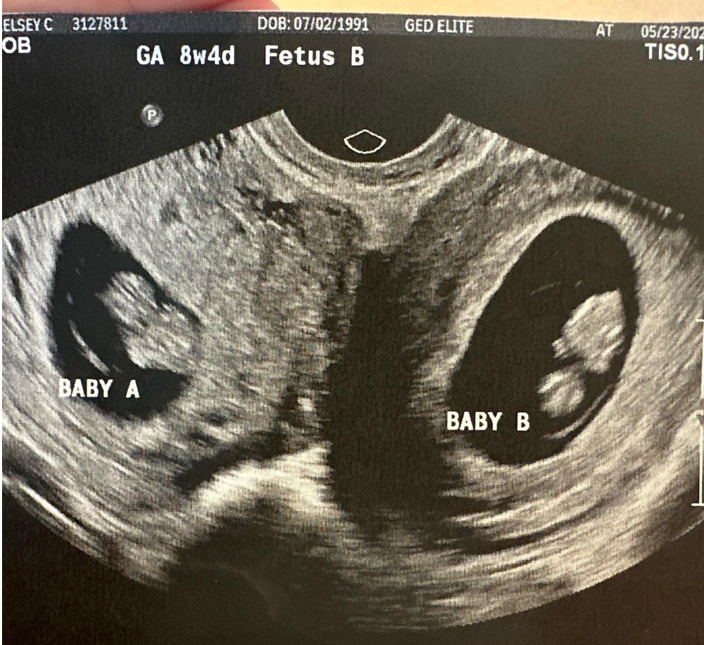 b超检查显示,凯尔西·哈彻的两个子宫同时妊娠.图源/ig