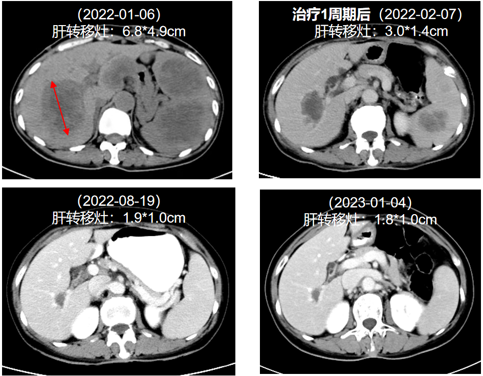 图2. 治疗前后肝转移灶变化