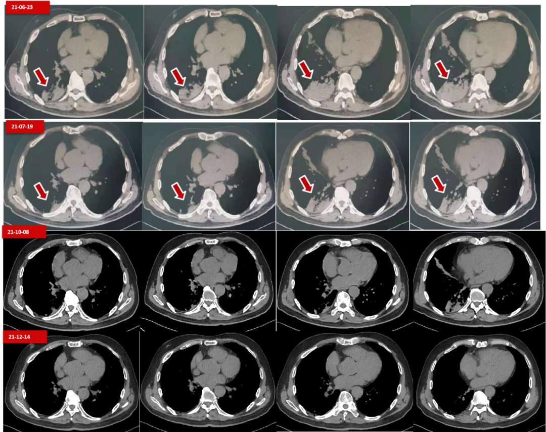 多次进展仍获得超5年长生存,这例braf突变晚期肺癌患者是如何做到的?