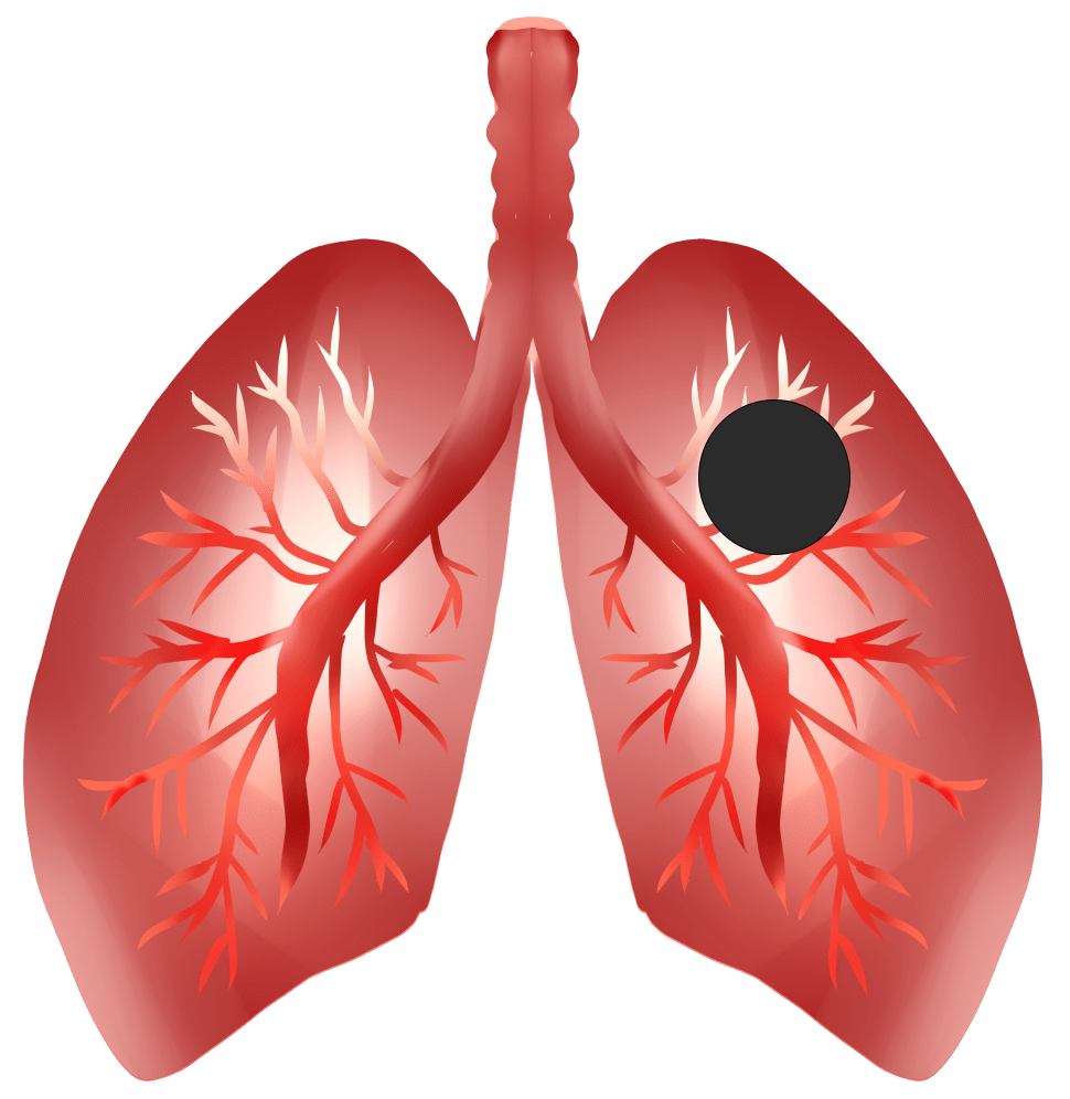 咯血是肺癌的第二个常见症状,常表现为血丝痰.