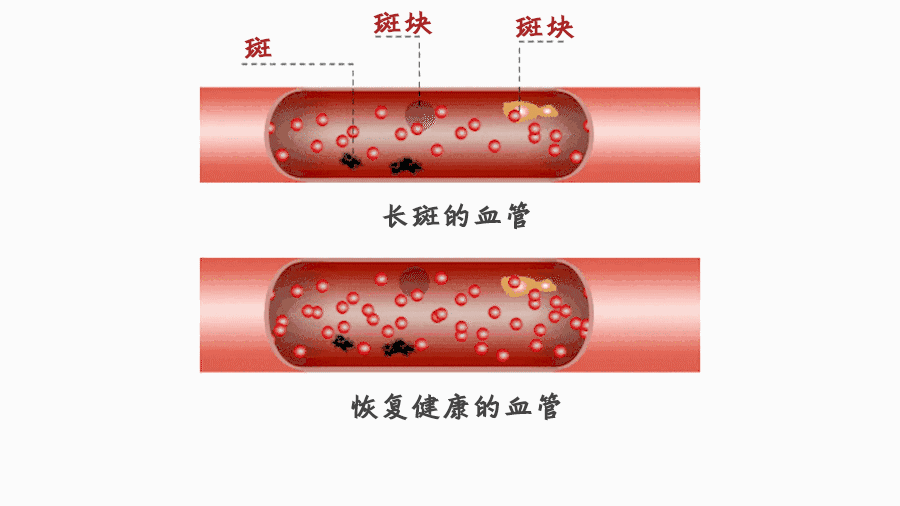 想知道血管里有没有斑块？用这个方法判断最便捷→|血管_新浪新闻