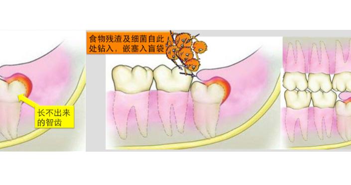 智齿冠周炎，比牙疼还可怕的存在|智齿冠周炎|智齿_新浪新闻