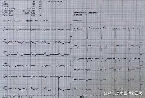 术后心电图(qrs波宽度约为120ms)