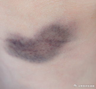 身上为什么总有莫名的淤青淤青是因为皮下出血造成的红肿……|淤青|毛细血管|红肿_新浪新闻
