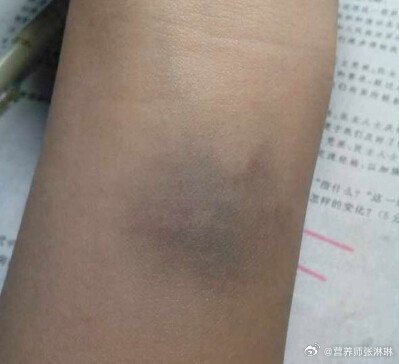 为什么淤青会有各种颜色？|胆绿素|血红素|毛细血管|紫红色|胆红素_新浪新闻