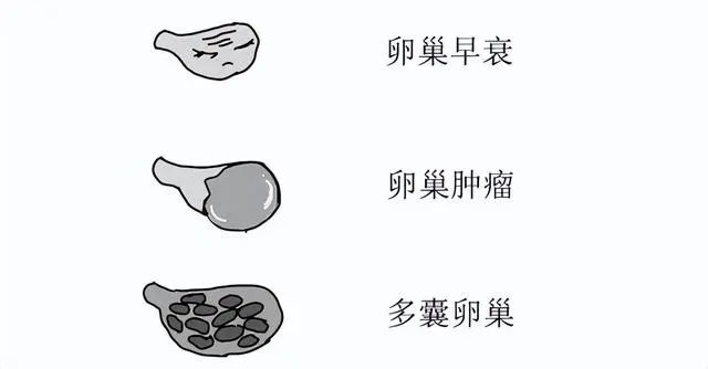 女生未满19岁确诊卵巢早衰|卵巢早衰_新浪财经_新浪网