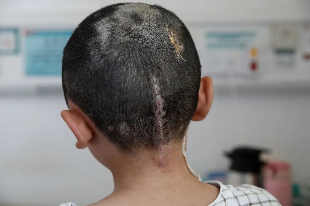 小华术后头部创口愈合