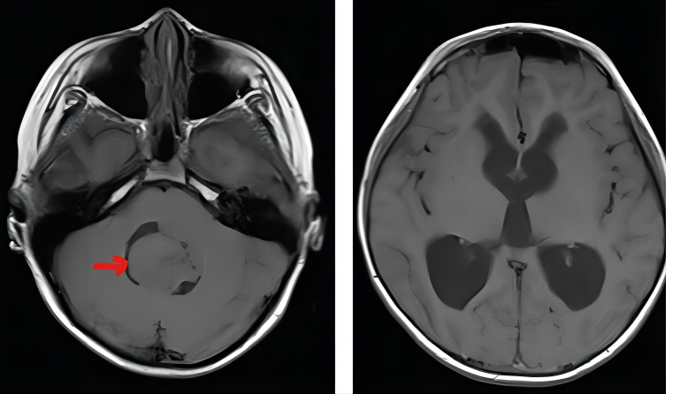 11岁儿童走路不稳伴头痛呕吐,原来是脑袋里面长"东西"|肿瘤_新浪财经_
