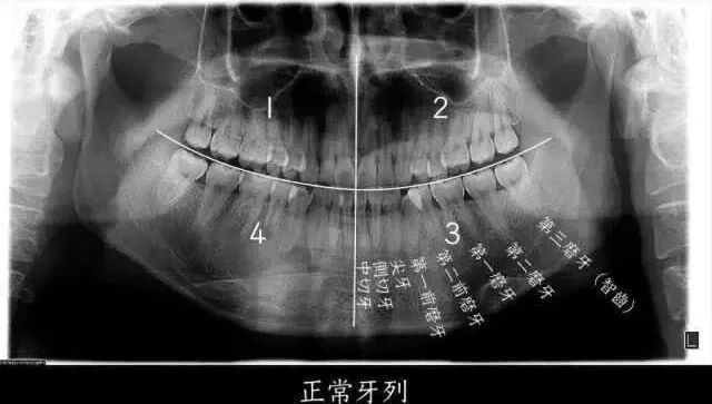 ▲ 智齿即第三磨牙，位于口腔最远最深位置。图源：浙江大学医学院附属第二医院何剑亮医生