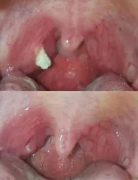扁桃体结石脱落前后