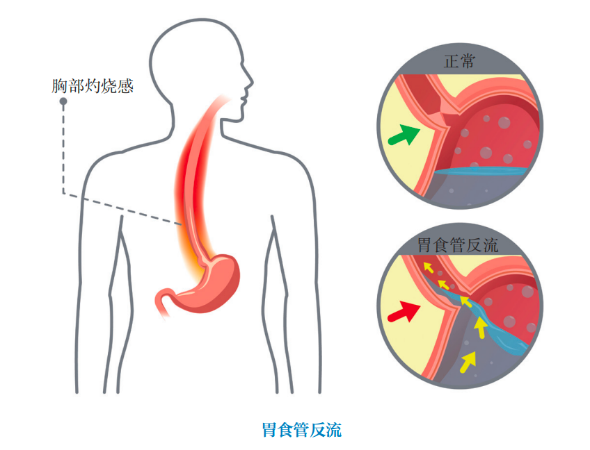 "吃出来"的癌症!喉咙出现这 4 种症状,可能是食道癌预警……|食管癌_