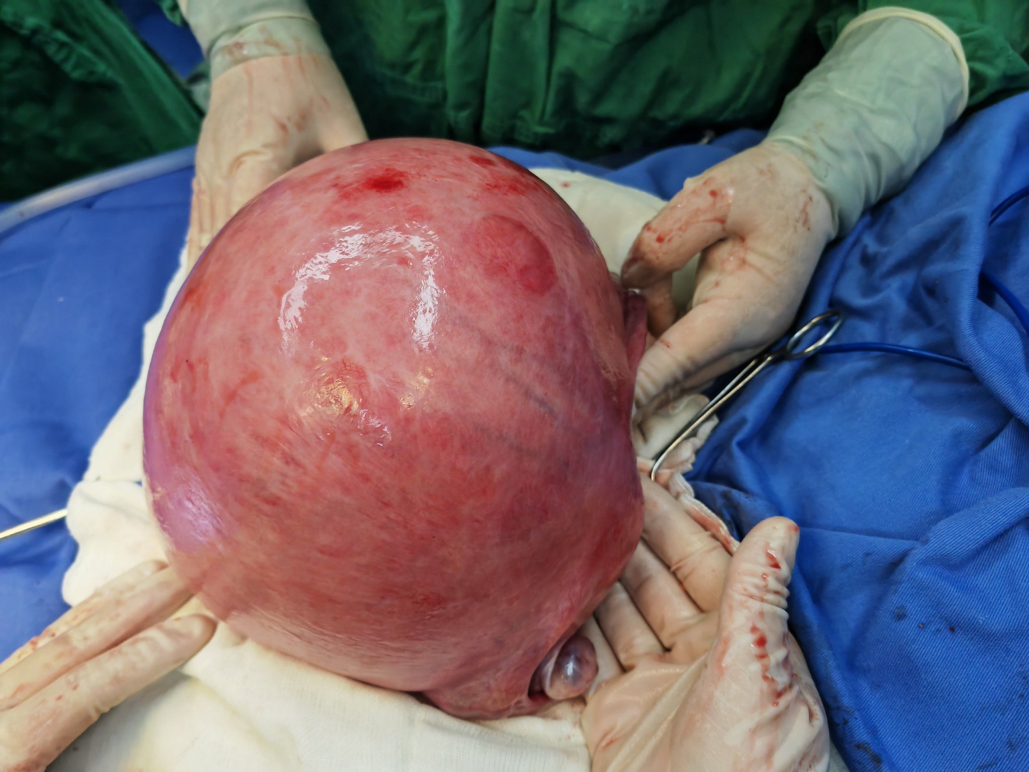 应急总医院张欣团队成功切除重达5斤半的子宫肌瘤