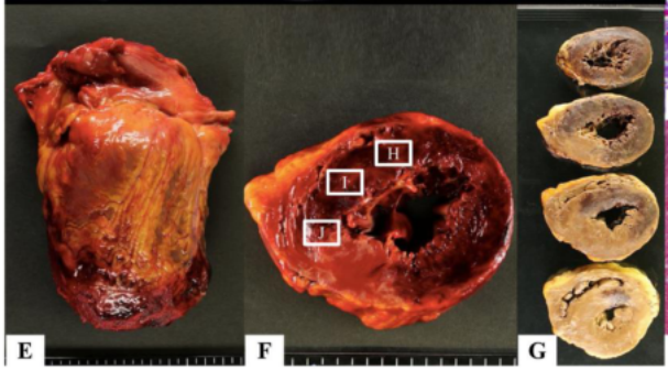 前壁,侧壁心肌出血,病理切片可见凝固性坏死,微血管阻塞和收缩带坏死