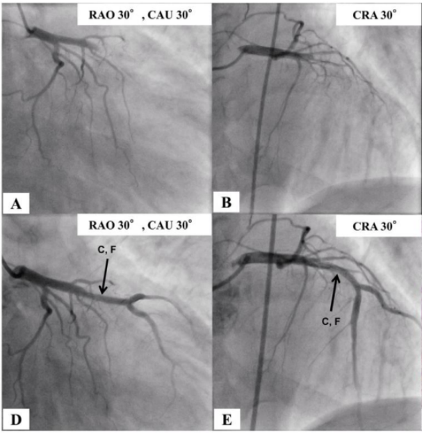 图1 冠脉造影示前降支支架内闭塞及药物球囊扩张术后