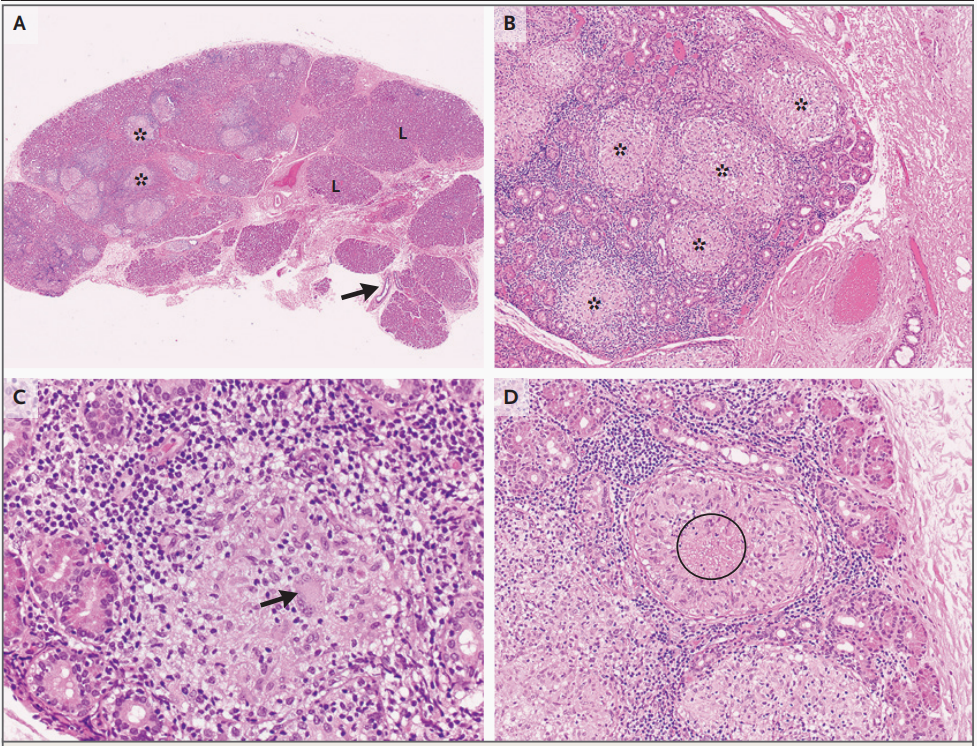 高倍镜下可见肉芽肿形成(图4b),由组织细胞组成