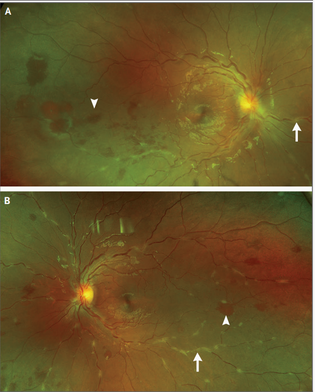 图1 原始影像结果(从左到右为a,b,c)眼底检查示:(图2)双眼玻璃体白